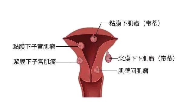 子宫肌瘤多大必须手术切除？（子宫肌瘤多大需要手术？)